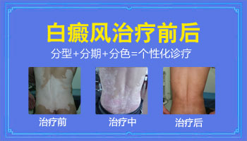 药物和仪器结合起来治白癜风好的快吗