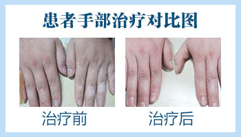 手指初期白癜风植皮案例图