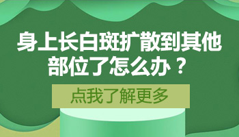 用什么方法治疗扩散期的白癜风比较好