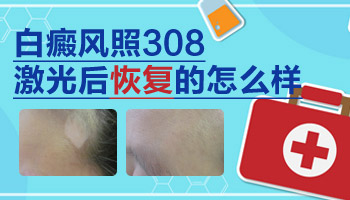 白癜风做308的恢复过程图  