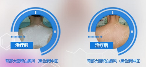 黑色素细胞培植治白癜风拆完纱布后的图片