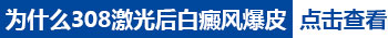 白癜风做一次308激光用多长时间