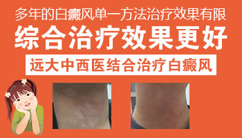 邯郸治疗白癜风用什么方法好