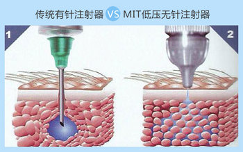 白癜风介入治疗是什么意思