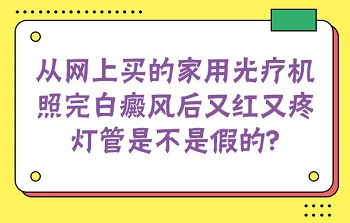 网上的308光疗仪可以买吗 治白癜风效果如何