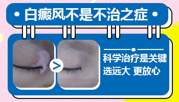 手部和嘴角白癜风三年了能治好吗