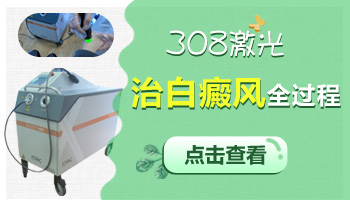 308激光治疗白癜风过程和效果