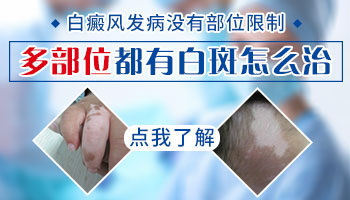 手腕内侧和腋窝都有白斑怎么治