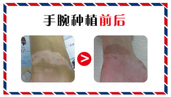 手腕内侧和腋窝都有白斑怎么治