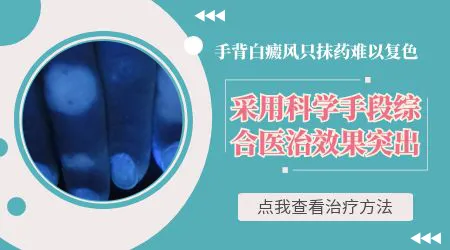 男孩手背一块白斑怎么治