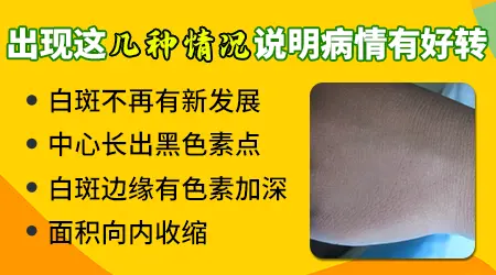 纳晶导入治疗白癜风效果怎么样