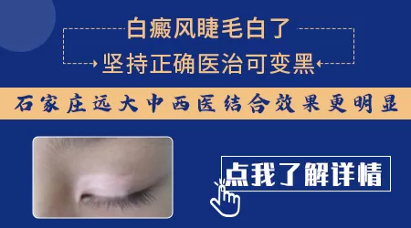 白癜风汗毛变白能不能治好