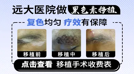 表皮黑色素移植治白癜风多少钱