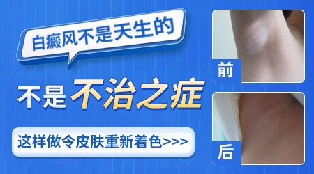 治好白癜风的方案都有哪些