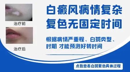 治白癜风大概要花多少钱
