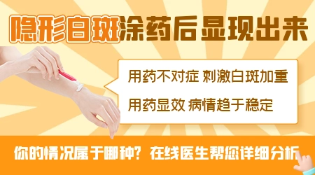 隐形的白癜风怎么治疗