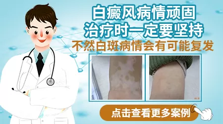 JAK抑制剂对白癜风效果怎样