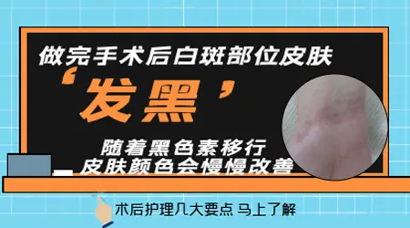 白癜风黑色素移植手术去邯郸哪家医院好