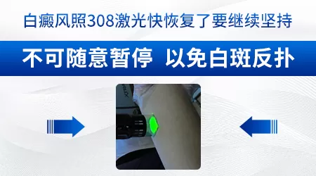 治疗白癜风308光疗仪哪个好