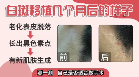 大面积白斑适合哪种手术治疗