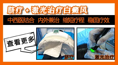 白癜风照美国进口308激光好的更快吗