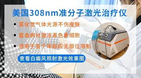 308nm准分子激光治疗白癜风效果好吗