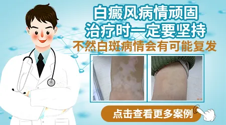 身上10%面积的白癜风怎么治好