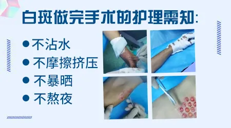 白癜风做一次手术能复色的几率大概有多少