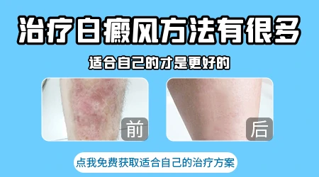 治疗白癜风最有效的方法是什么