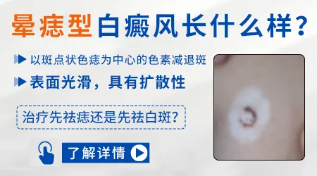 晕痣白癜风能不能治好