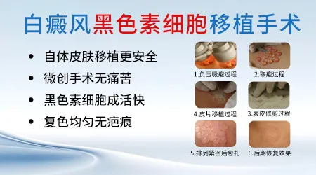 白癜风做黑色素细胞种植术靠谱吗