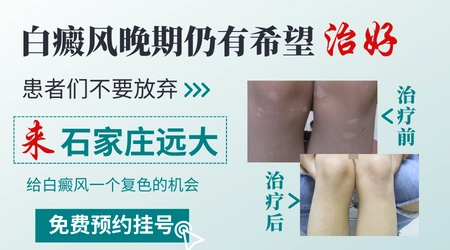 白癜风瓷白色还有希望恢复正常色吗