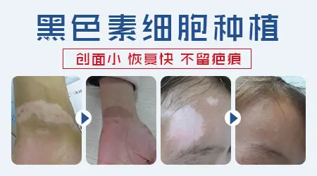 植皮手术适合所有稳定期患者吗