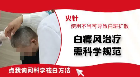 中医火针治疗白癜风效果怎么样