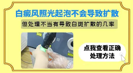 308激光照白斑起泡了怎么快速缓解