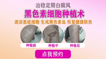 进展期白斑能做表皮移植手术吗