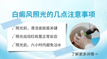 白癜风吃复方甘草酸苷片有用吗
