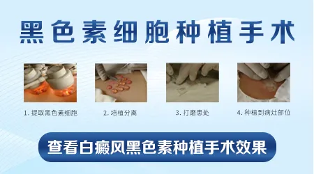 晕痣白癜风可以用植皮手术治疗吗
