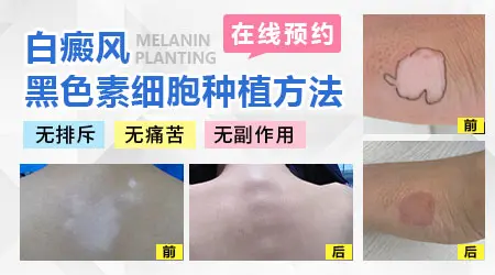 白癜风种植手术后还是发白是失败了吗