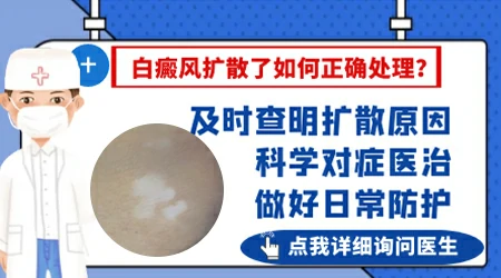 白癜风进展期要怎么快速控制