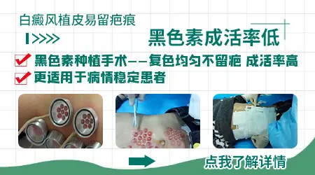 白癜风植皮和黑素细胞移植选哪个更靠谱
