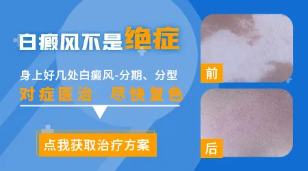 白癜风是不是终身治不好