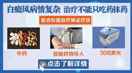 治疗白癜风的药膏都有哪些