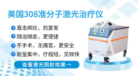 白癜风长期照308光会不会增加皮肤癌变的风险