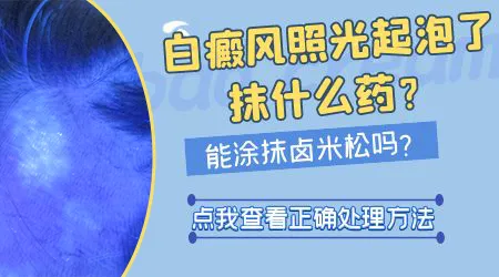 白癜风光疗后起小水疱会不会更加严重