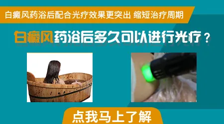 窄谱UVB光疗适合大面积白癜风白斑吗