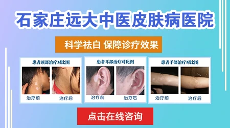 民间治疗白癜风有什么好的土方法