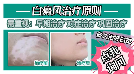初期白癜风怎么治疗能断根不会复发