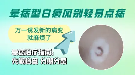晕痣白斑治疗大概需要多长时间能复色