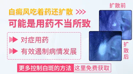 白癜风吃药抹药还扩散怎么办